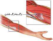 رگ به رگ شدن و در رفتگی