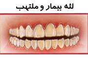 بيماري های لثه، خاموشند   