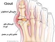 تغذیه در نقرس