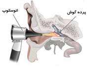پارگی‌ پرده‌ گوش‌