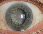 آب‌ مروارید