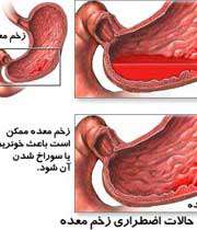 خون‌ريزي‌هاي گوارشي؛ علل و راه‌حل