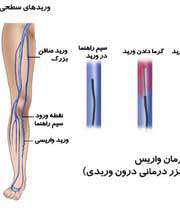 روش های درمان واریس