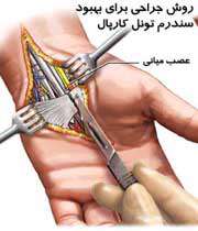 مچ ‌درد ناشی از کار