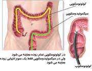 روش‌هاي تشخيص سرطان روده