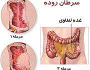 سرطان روده بزرگ، خاموش و مرگبار