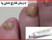 مراقب قارچ ‌پا باشید