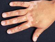 لکه های سفید پوستی