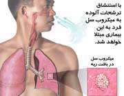 سل؛ طاعون سفید