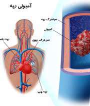 لخته شدن خون در ریه