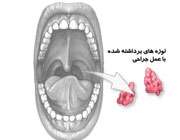 چه موقع لوزه ها را باید درآورد؟