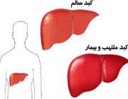 علایم هپاتیت C