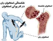 پوکي استخوان خبر نمي کند