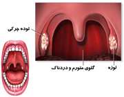 راهکارهای درمانی عفونت لوزه راهکارهای درمانی عفونت لوزه