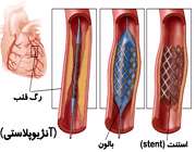 باز کردن عروق قلب با آنژیوپلاستی