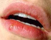 چرا تبخال؟