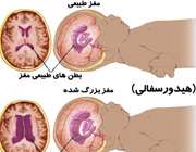 آب گرفتگی مغز