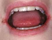 گوشه دهان تان زخم می شود؟