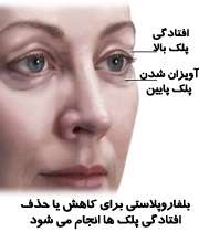 جراحی زیبایی پلک چشم