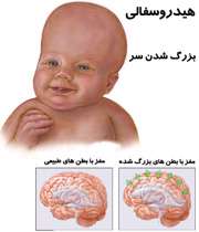 در هیدروسفالی، سر بزرگ می شود