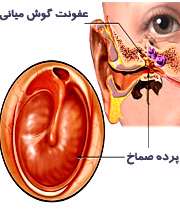 عفونت گوش منجر به پارگي پرده گوش مي ‌شود