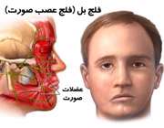فلج یک طرف صورت