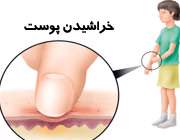 چگونه از شر خارش خلاص ‌‌شويم؟