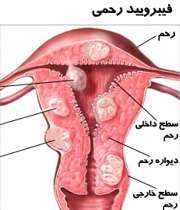 فيبروم، بيماري شايع در خانم ها