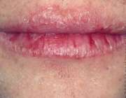 خشکی لب‌ها