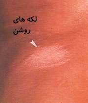 جذام را جور دیگری ببینید