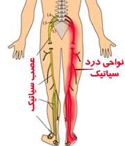 خیلی‌ها از درد سیاتیک می‌نالند