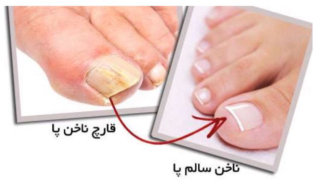 خطرات نادیده گرفتن قارچ ناخن