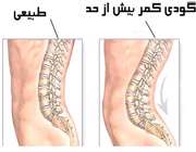 اگر گودی کمر دارید بخوانید...