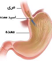 طب سنتی به داد معده هم می‌رسد