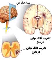 علائم بیماری ام اس و اثر گیاهان دارویی بر درمان آن 