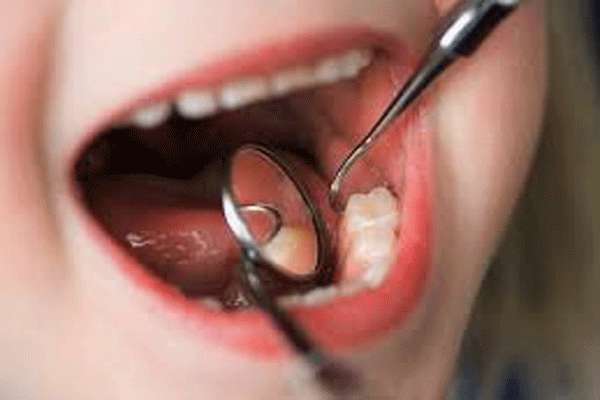 تولید ماده پرکننده دندان از پوست تخم مرغ