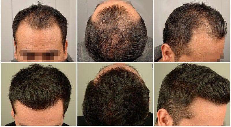 کاشت مو به روش SUT در کلینیک رنسانس