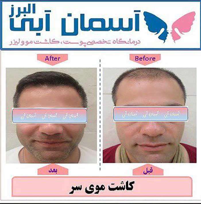 تزریق چربی 