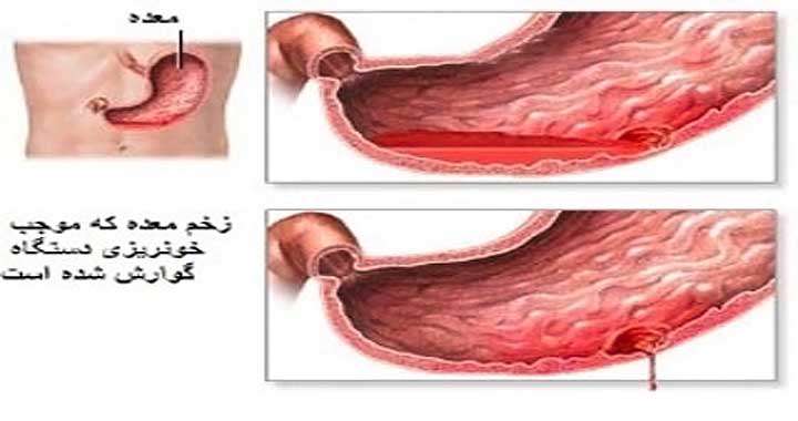 استفراغ خونی