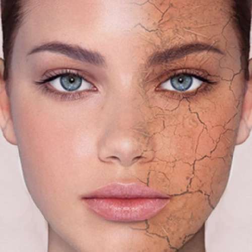 خشکی پوست چیست و چه کسانی به این اختلال مبتلا می شوند ؟