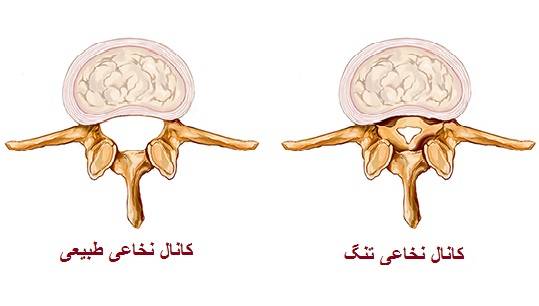 تنگی کانال نخاع چیست؟