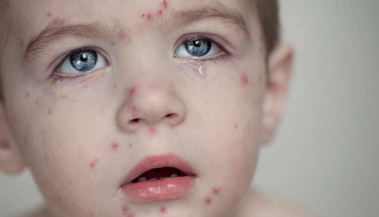 آبله مرغان چیست و چگونه درمان می شود؟