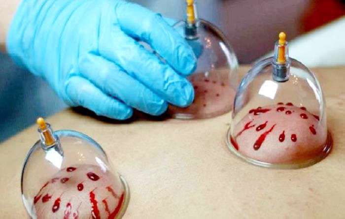 حجامت چیست و چه فوایدی دارد؟