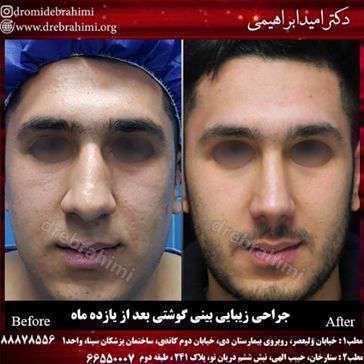 تفاوت جراحی بینی گوشتی و استخوانی چیست؟