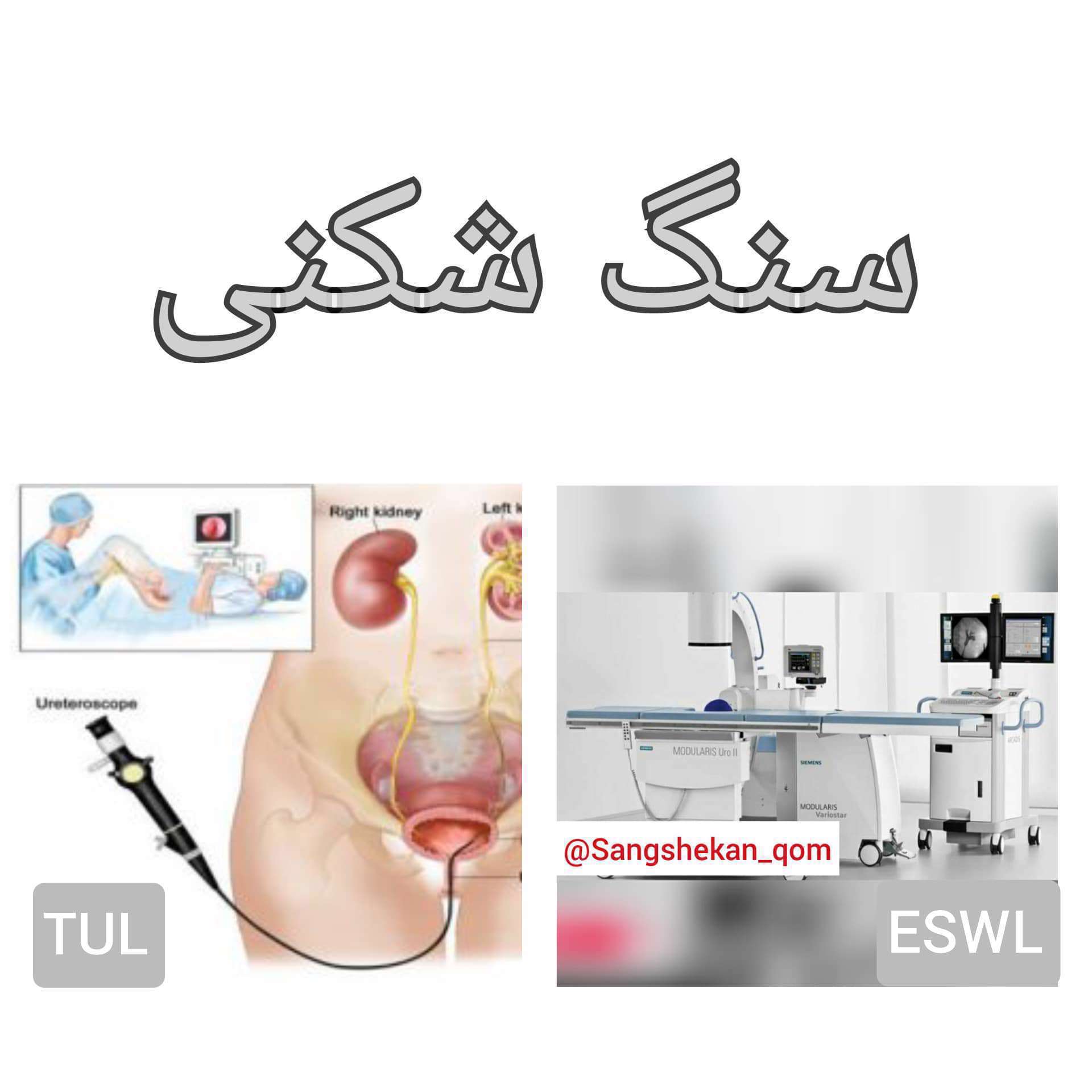 درمان تضمینی سنگ کلیه بدون جراحی و بیهوشی
