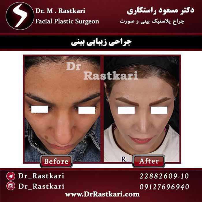 عمل زیبایی بینی ، یک جراحی حساس و حیرت انگیز