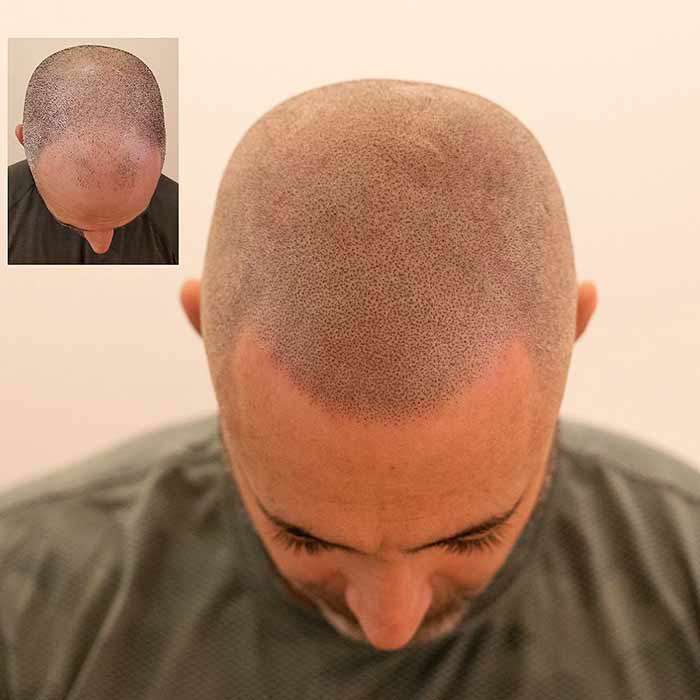 باید و نبایدهای میکرواسکالپ، مزواسکالپ و مزوتراپی مو 