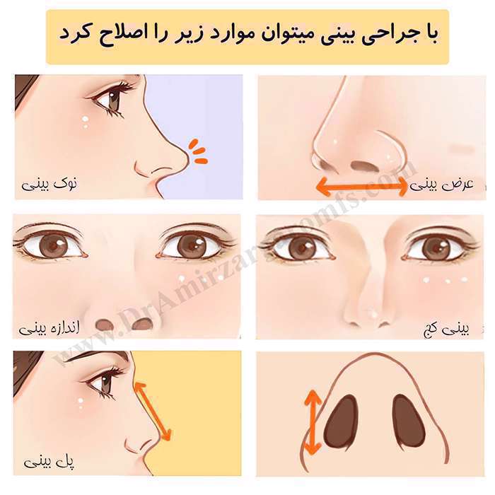 عمل بینی و چک لیست نکات مهم قبل از عمل جراحی بینی