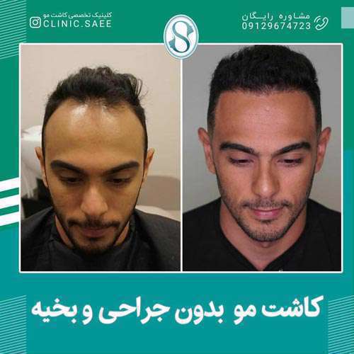کاشت مو با بانک موی ضعیف چگونه انجام می شود ؟