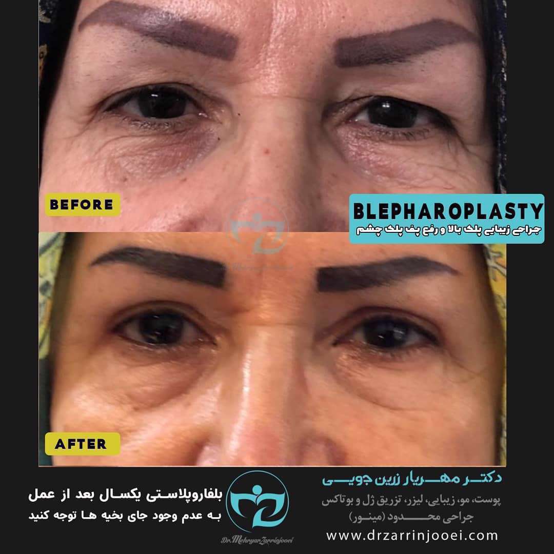 رفع پف چشم و افتادگی پلک با روش بلفاروپلاستی